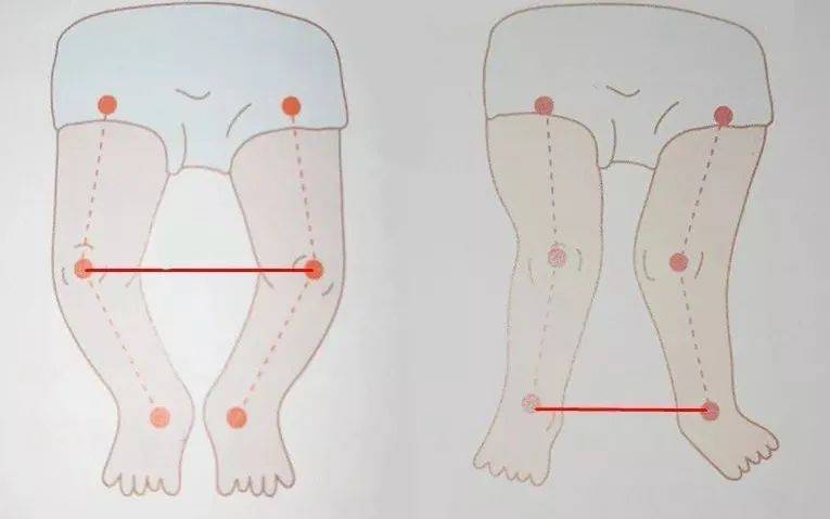 预防宝宝罗圈腿?这些错误做法要不得!
