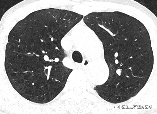 ct经典图谱:肺气肿ct典型图谱,一学就会