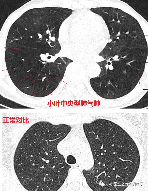 ct经典图谱:肺气肿ct典型图谱,一学就会