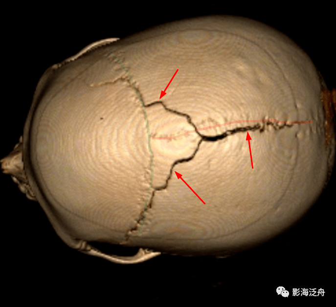 注意鼻尖的位置,浅绿色线条代表冠状缝,浅红色线条代表矢状缝,红箭头