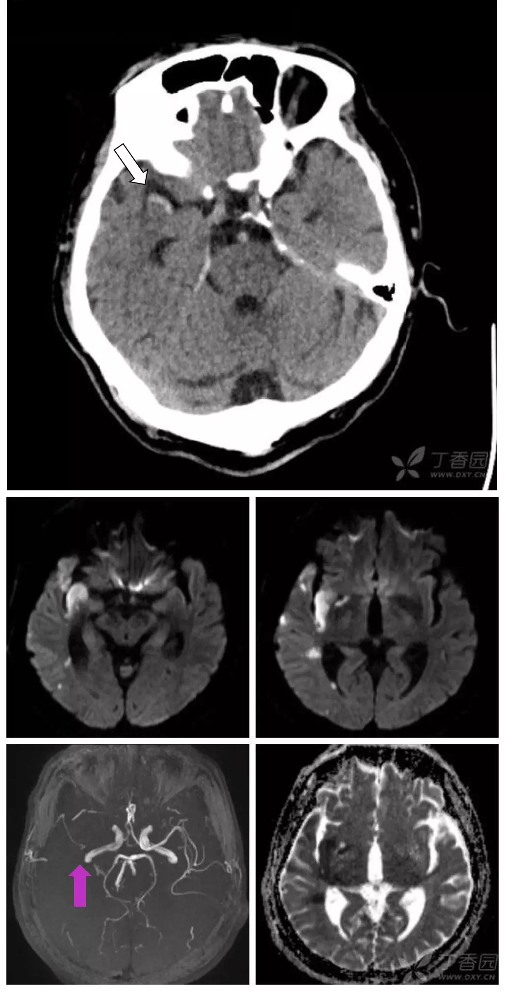6 个病例学会「脑梗死」的 4 大 ct 征象