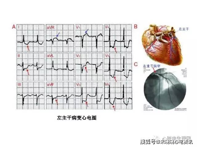 左主干病变心电图