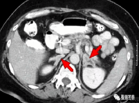 肾上腺病变的ct诊断
