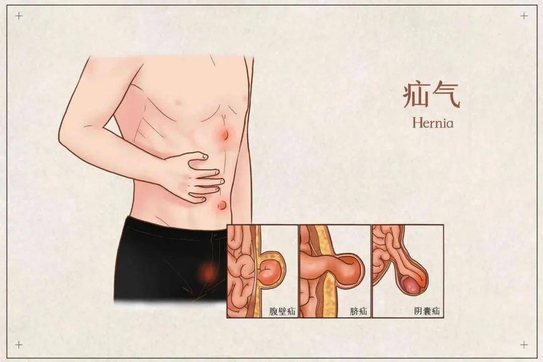 是指在人体腹股沟韧带附近 发生的疝气包块 疝气,即人体组织或器官一