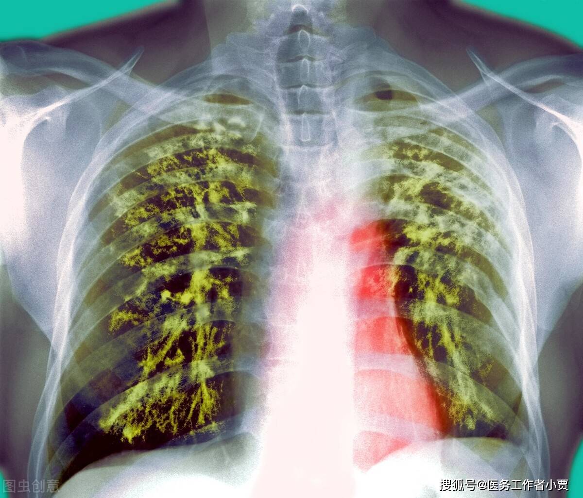 肺结核与肺癌有什么不同?