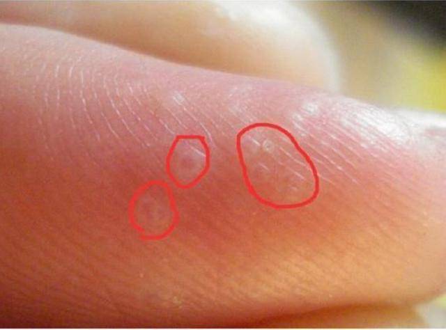 汗疱疹不具有传染性,但它通常发生在双手,除了影响了手部的美观还