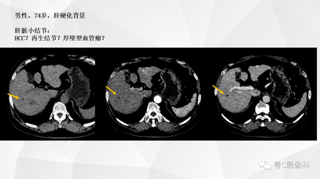肝脏ct/mri增强扫描"快进快退"的诊断思路