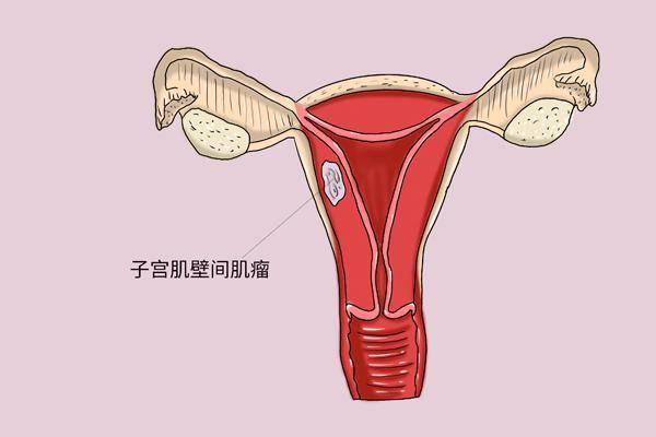 宫茹清科普子宫息肉最青睐3种人到底严不严重是否需要切除