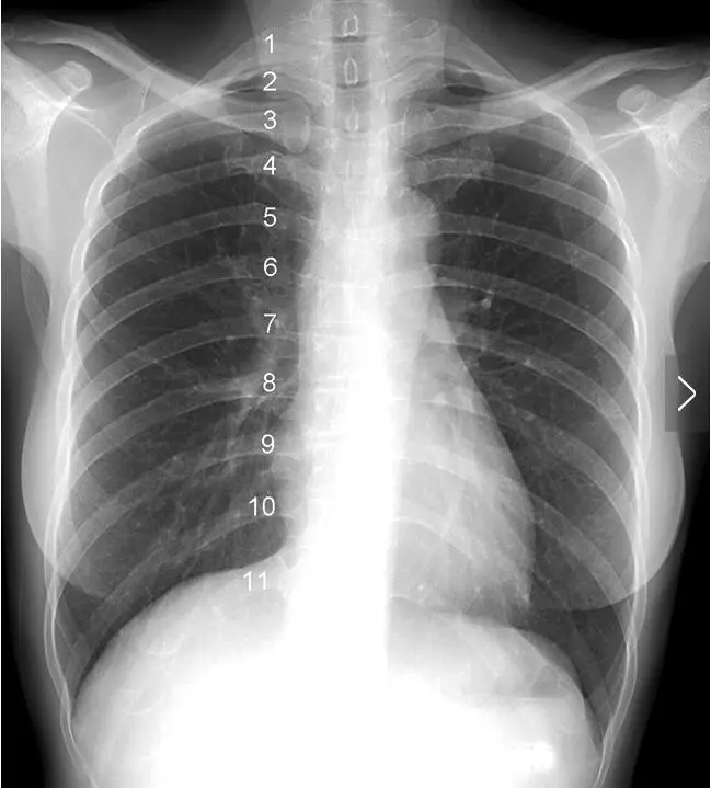 影像解剖入门 | 正常胸片怎么看?