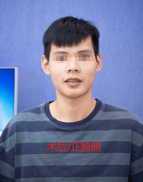 案例分享,正颌手术让他从"猿人"摇身一变气质男神!