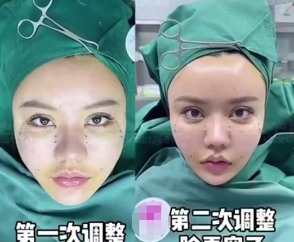 韩安冉整容还不到一个月又"动了"四个地方,手术过程看着恐怖