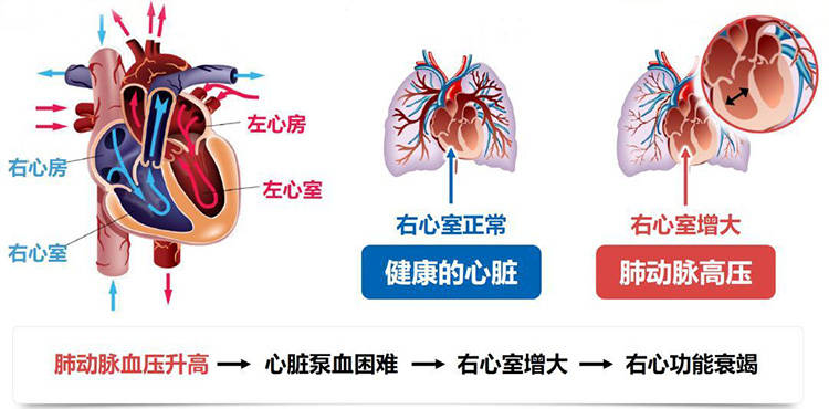 肺动脉高压,是另一种不能轻视的"高血压"