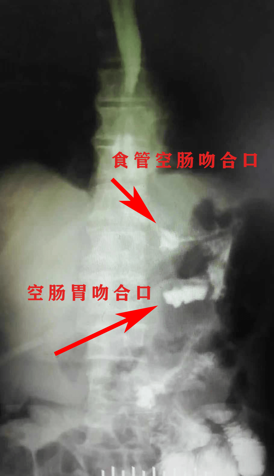 在其高超的手术技术下,从容不迫地清扫相应的淋巴结,切除近端胃大部