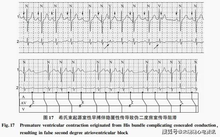 希氏束起源室性心律失常心电图特点