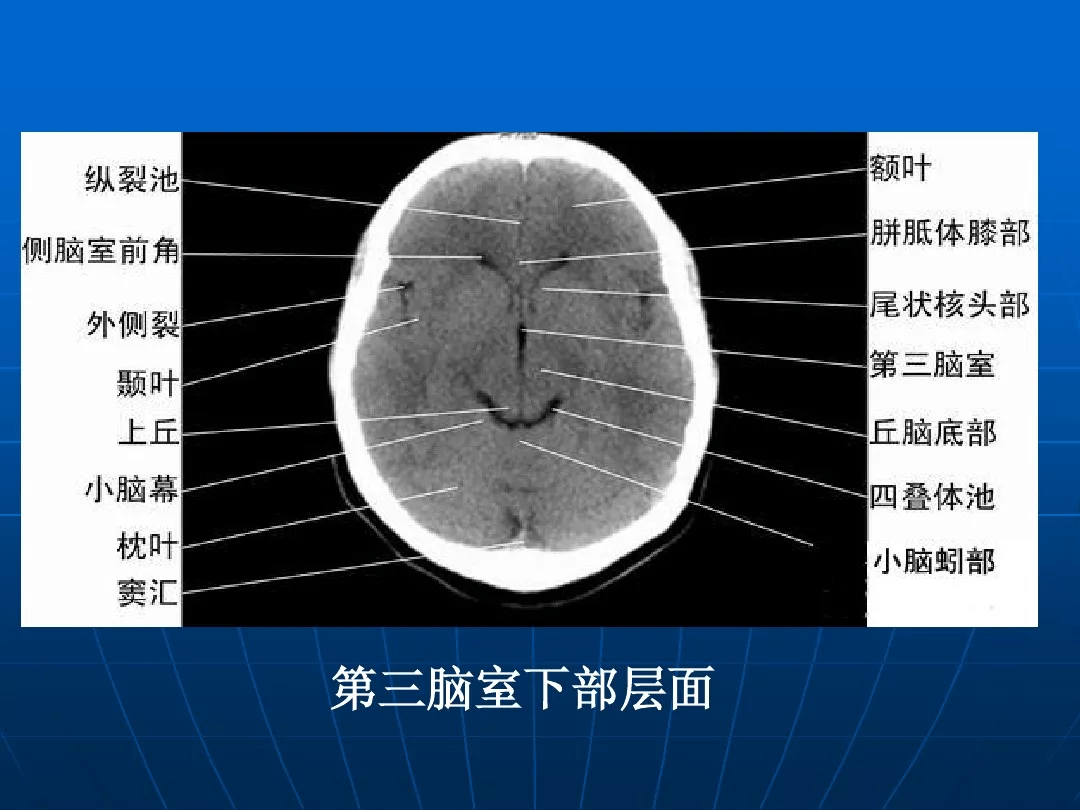 影像总结头颅ct基本知识与常见病变