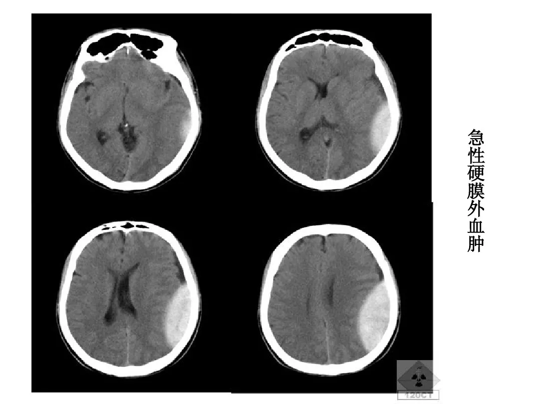 影像总结:头颅ct基本知识与常见病变