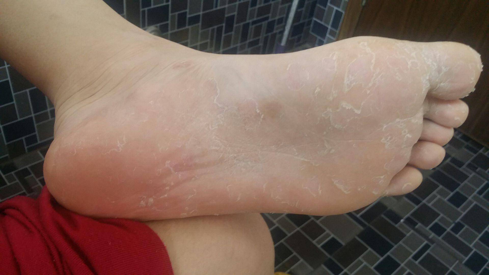 原创为什么脚趾缝里脱皮,瘙痒,溃烂?早期时注意一种皮肤病