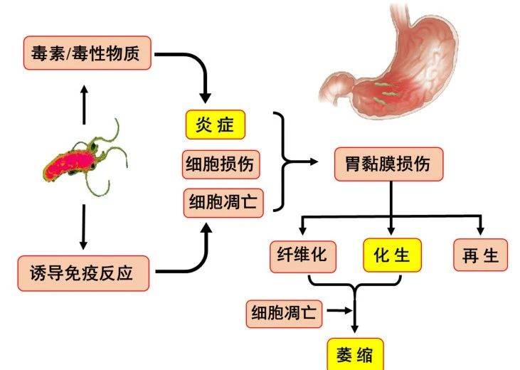 胃镜报告显示"肠化",我会得癌吗?