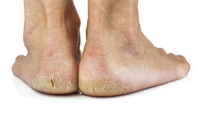 原创经常性脚后跟干裂起皮,不止是缺乏维生素,当心是健康在"呼救"