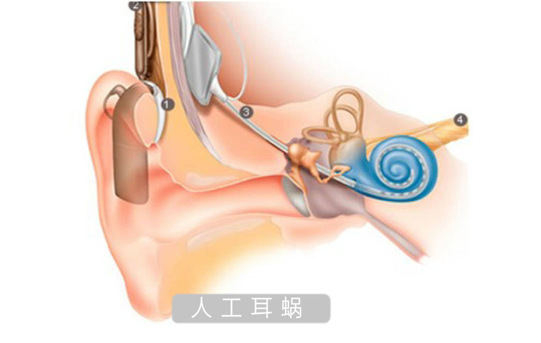 人工耳蜗的工作原理