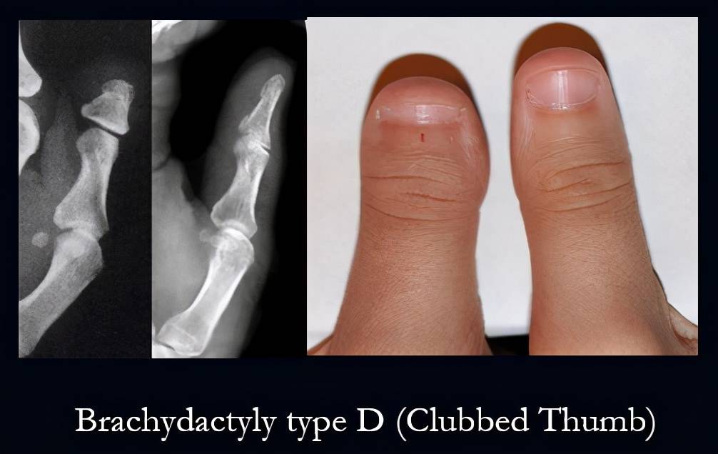 其中最常见的d型短指症是困扰很多人的 "粗短大拇指",病.