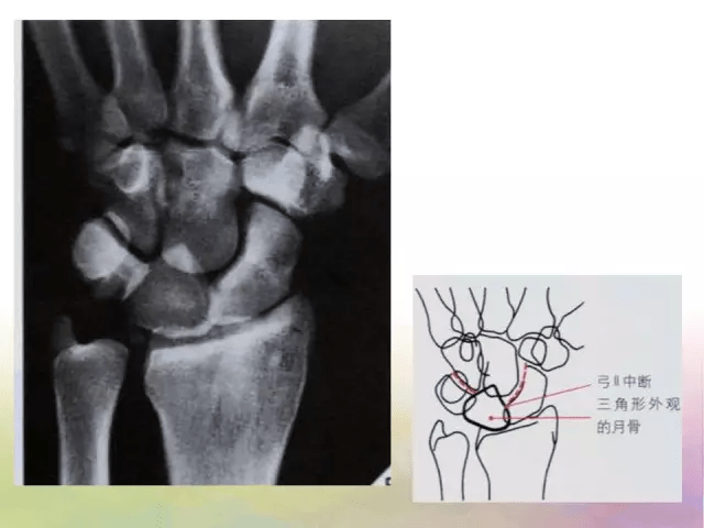 基础学习腕关节解剖详解