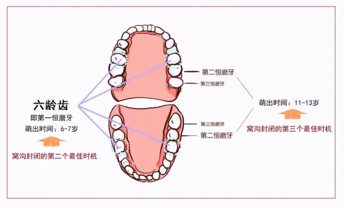 口腔医生:为什么儿童需要窝沟封闭?