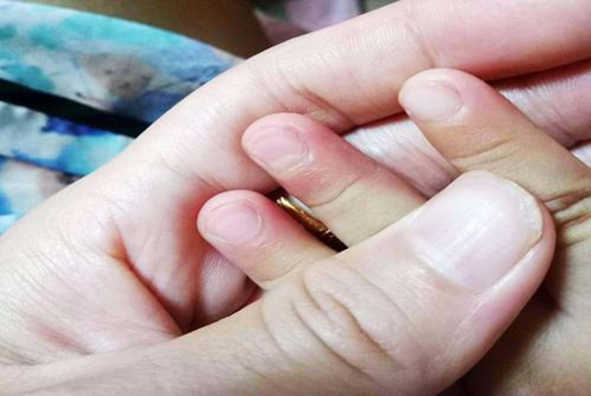 原创总忍不住咬指甲,到底是生病了还是正常现象?医生:这种行为得治