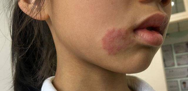 9岁女孩脸上出现红疹,却误被当做湿疹治疗