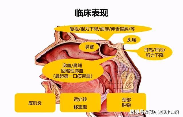 原创35岁男子查出鼻咽癌,已做20次放疗!呼吁:这些症状别当鼻炎