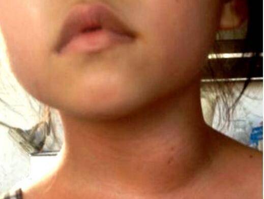 11岁女孩查出"大脖子"病,医生:这3种零食吃太多,家长有责任