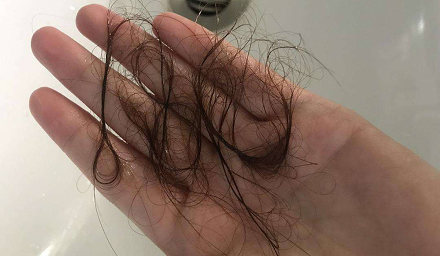 原创秃顶的人有救了《自然》的最新研究发现:或许有办法重获头发