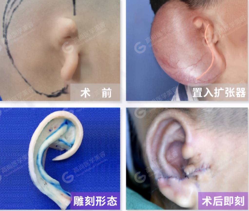 一期手术,在残耳后乳突区埋置水囊(即扩张器),后定期注水扩张.