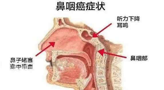 鼻出血是上火?33岁男性查出鼻咽癌,一些症状别当成鼻炎