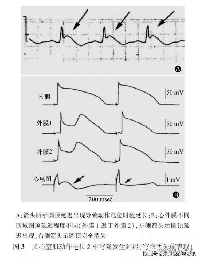 心外膜动作电位圆顶形成于 2 相时期,故称为 2 相折返机制 . 4.