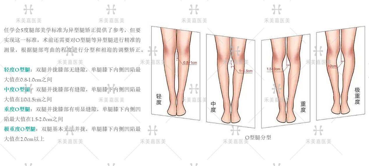 o型腿分类示意图