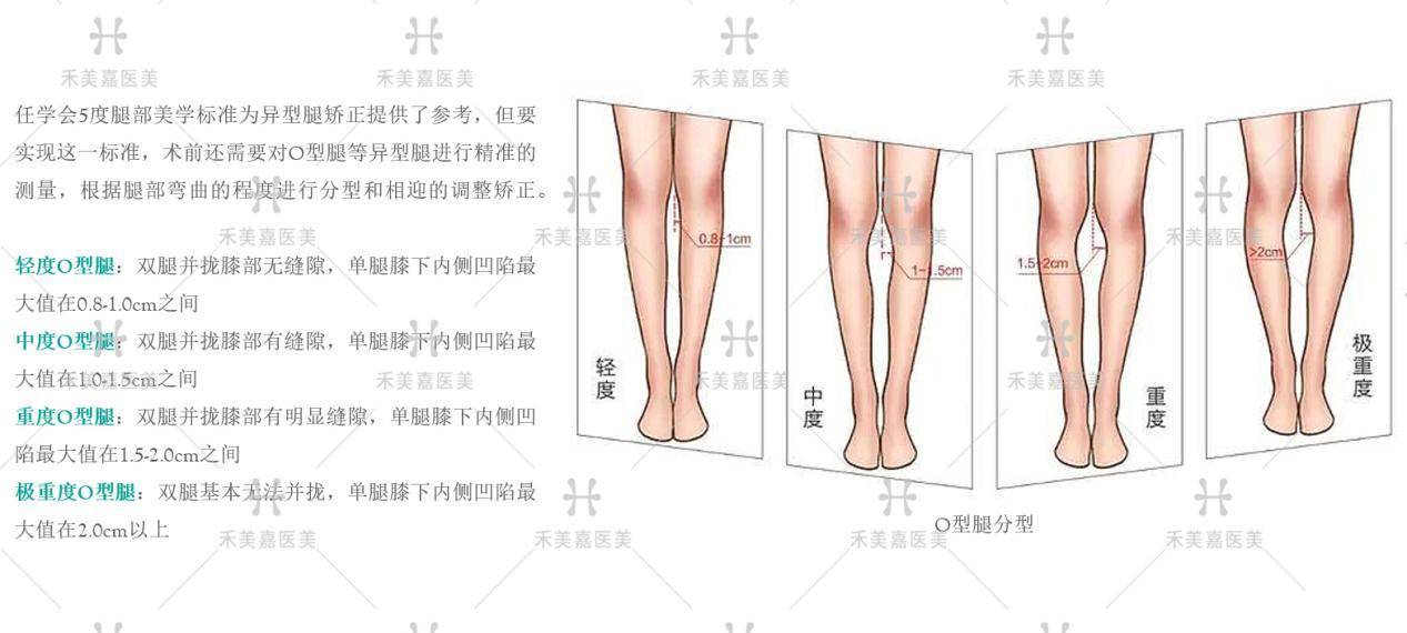 北京最好自体脂肪矫正腿型专家关几梦:o型腿怎么矫正更好?