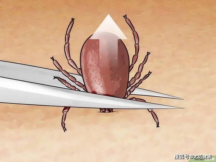 拍打和生拉硬拽很容易将蜱虫的头部残留在人体内,造成继发感染.