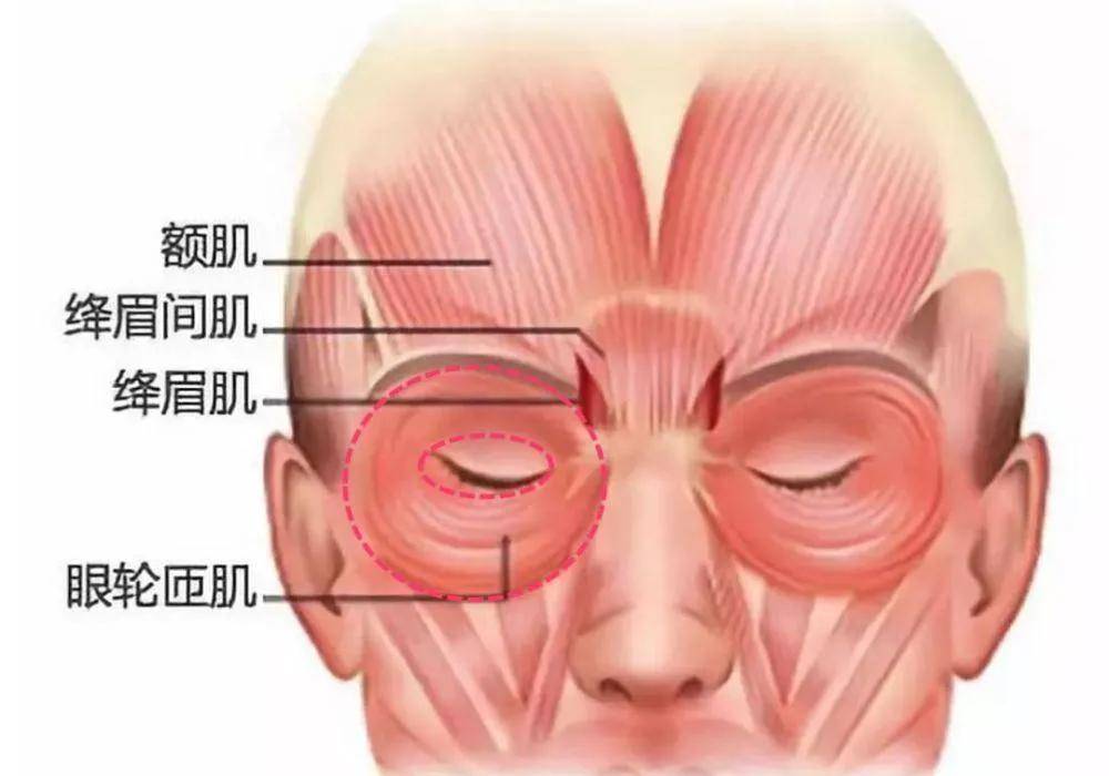 眼轮匝肌肥厚当眶骨外凸程度不够,眶隔膜包不住脂肪团就会溢出框骨外