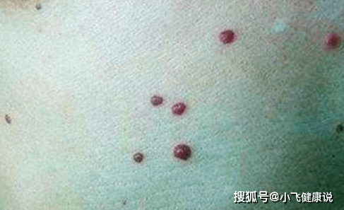 身上突然长了很多小红痣,是什么原因?其中1个需警惕,不可忽视