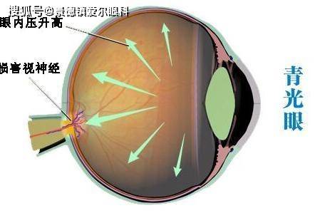 什么叫做急性闭角型青光眼?