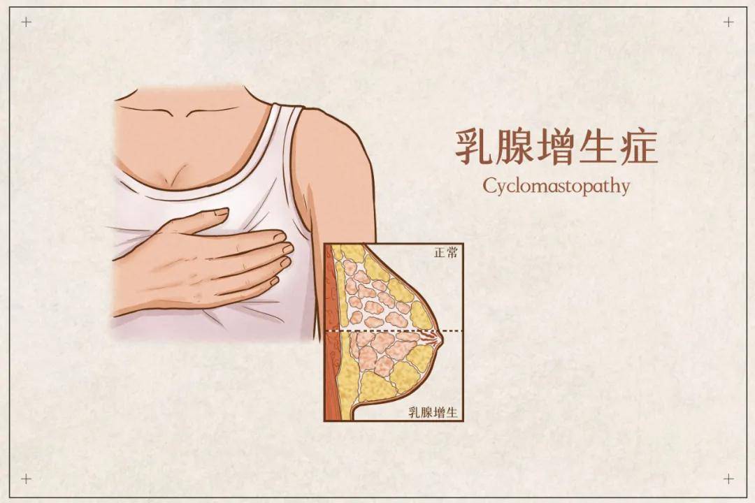 女性乳腺的"豹纹征—囊性增生_乳房