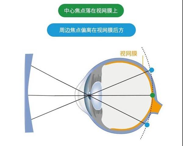 镜片:采用近视离焦原理,让周边焦点落在视网膜前面,给眼球一个"停止向