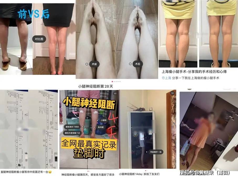 后遗症也一抓一大把: 因为切断的肌肉神经再也无法复原.
