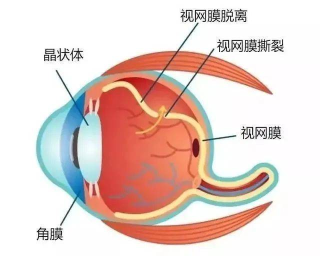 高度近视眼的眼轴不断拉长,造成视网膜,脉络膜之间的循环障碍,供血不