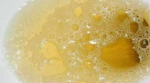 尿液中有泡沫就是蛋白尿?并非如此,你还需要知道这一点!