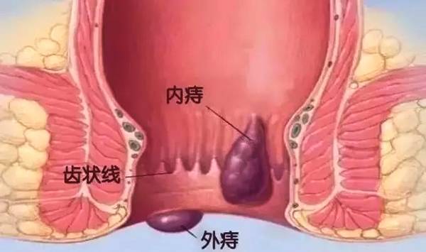 这是由于痔疮可引起排便疼痛,特别是在内痔发生脱出并绞窄时,可使病人