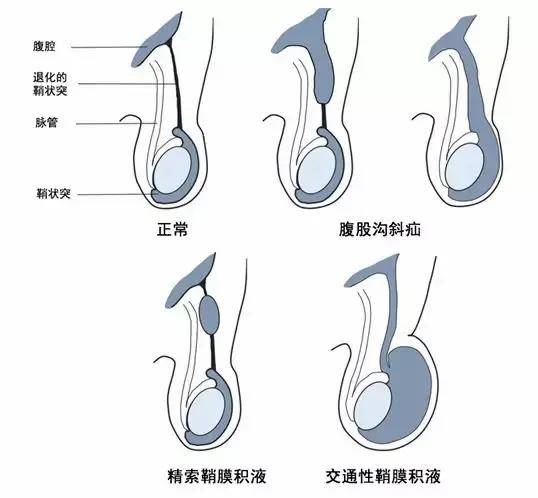 半月线疝,在双大腿内侧的有腹股沟疝,而腹股沟疝又因其位置的不同可分