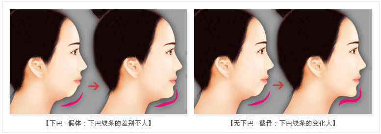 颏成型手术和正颌手术区别是什么?_下巴