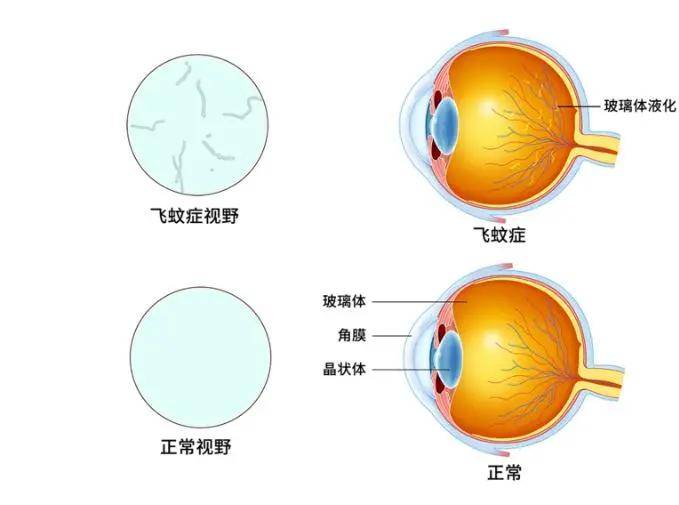 晶视达视力 | 15岁少年错失防控良机,近视2500度无奈辍学!